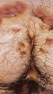fistola cronica cisti pilonidale