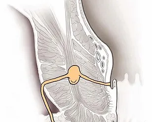 Fistola Anale Natale Ursino