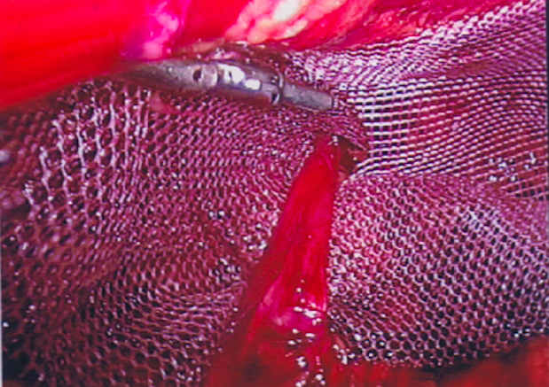 Laying the Mesh