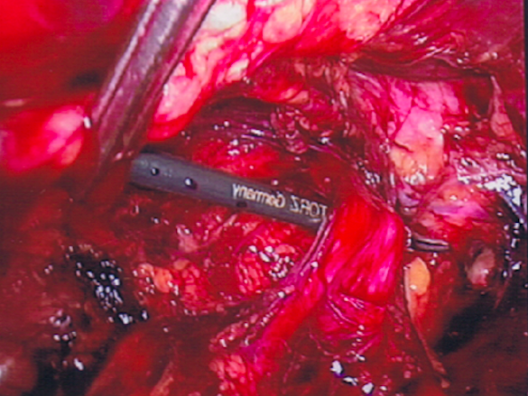 Dissection of Inguinal Cord