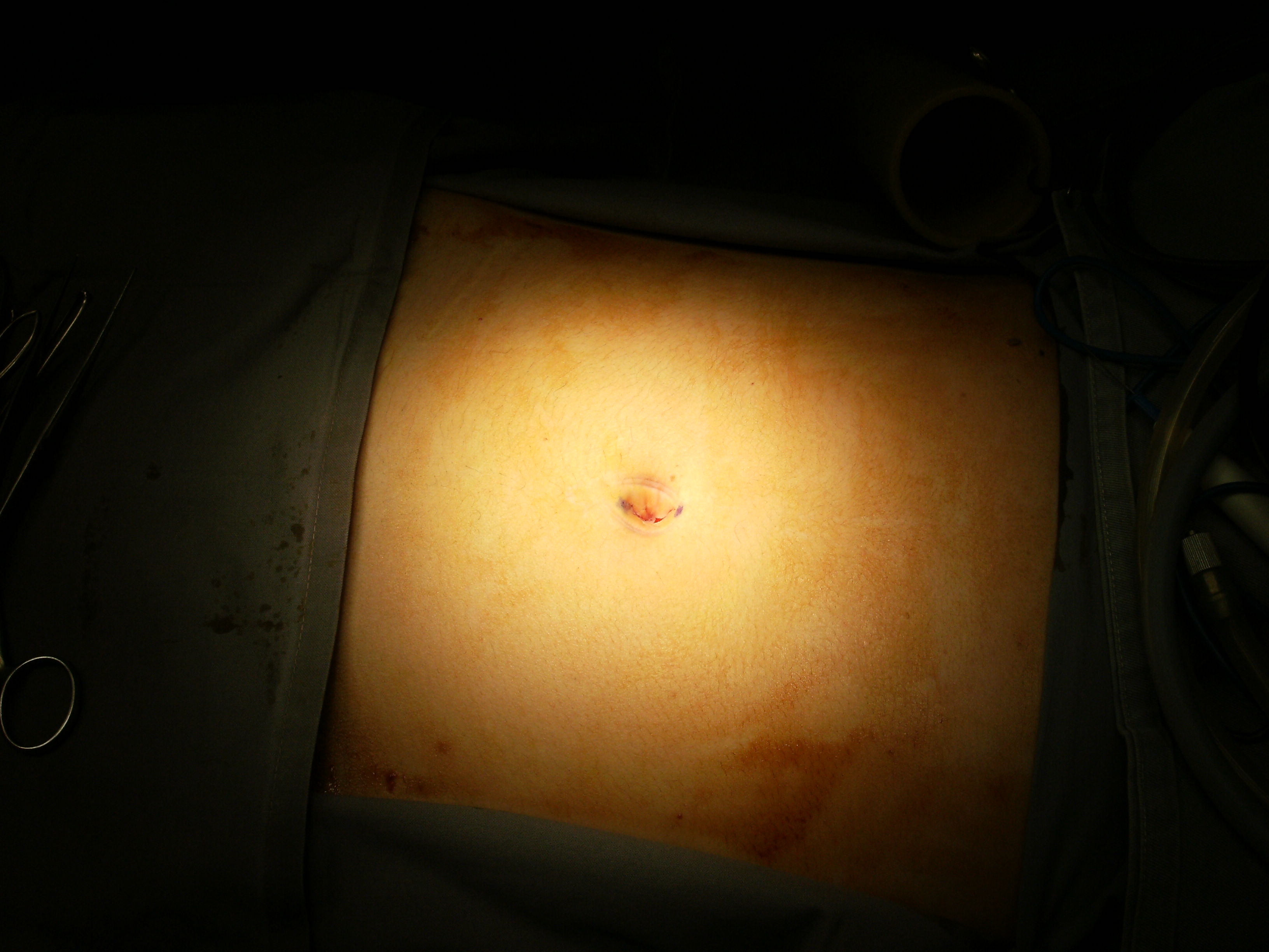 Incision marked within umbilicus