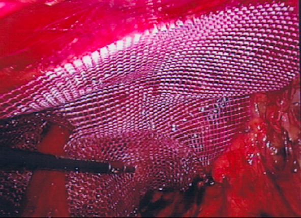 Laying the Mesh