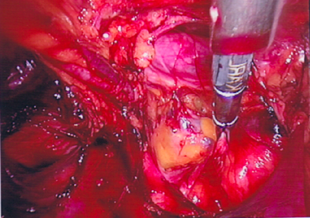 Dissection of Direct Inguinal Hernia