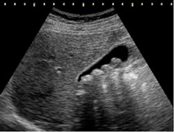 Ultrasound scan showing gallstrones in the bladder
