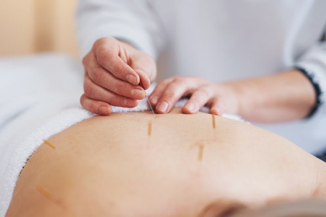 An image showing acupuncture therapy in progress.