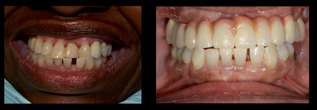 before-and-after-tooth replacement.png