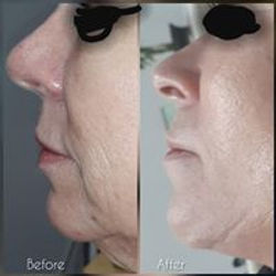 Kinsley PRP face neck chest