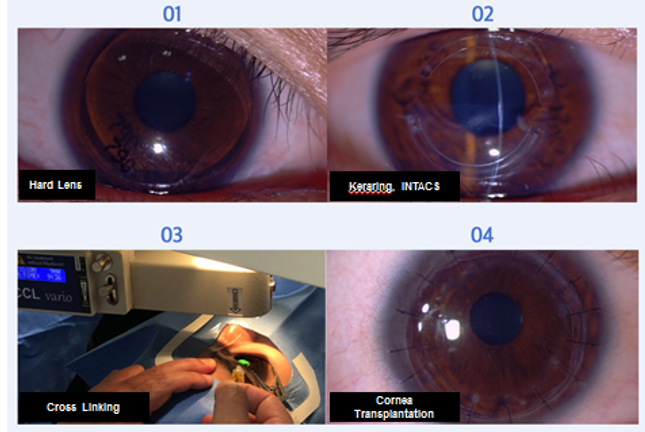keratoconus1.png