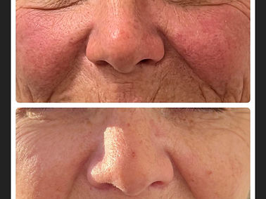 IPL Before and After