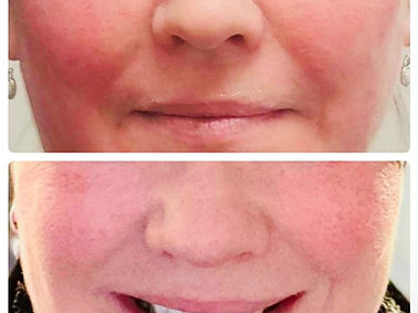 Rosacea Before and After