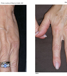 LF_hand_Adatto_01_1A_5wks_left.jpg