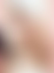 暗瘡就好比冤鬼纏身