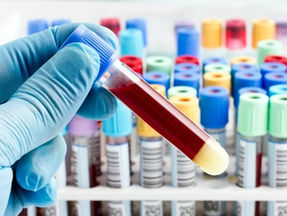 Karaciğer ve Böbrek Hastalıklarının kötü sonlanmaması için Hemogram ve Biyokimya parametrelerinin Önemi