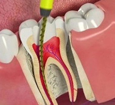 Root-Canal-Procedure-Guide.jpg