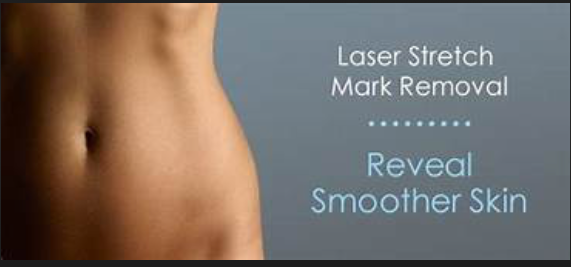 Laser stretch mark removal