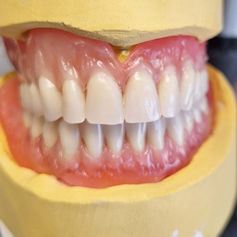 Uitneembare prothese