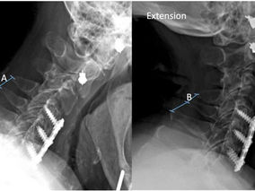 Does screw length for primary two-level ACDF influence pseudarthrosis risk?