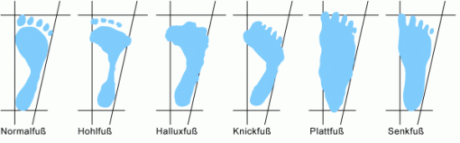 Fussdeformationen.gif