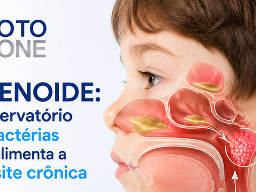 rinossinusite crônica pediátrica, sinusite infantil, tosse persistente noturna infantil, adenoide aumentada, adenoidite crônica, hipertrofia de adenoide, cirurgia de adenoide criança, tratamento sinusite crônica, biofilme bacteriano nasal, lavagem nasal criança, tomografia seios da face infantil, cirurgia endoscópica nasal, fess infantil, sinuplastia com balão criança, otorrinolaringologista pediátrico sp, clínica otorrinolaringologia sp, Dr Bruno Rossini, Clínica Oto One, secreção nasal persistente, gotejamento pós nasal criança, nariz entupido crônico infantil, ronco infantil tratamento, respiração oral criança, antibiótico sinusite infantil prolongado, rinite alérgica e sinusite, asma e sinusite criança, imunodeficiência infantil, halitose infantil causas, otorrino especialista em adenoide são paulo, carne esponjosa nariz.
