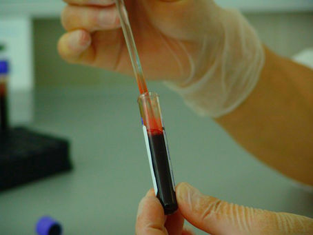 VIH/SIDA à Madagascar : 2190 personnes infectées en 2021