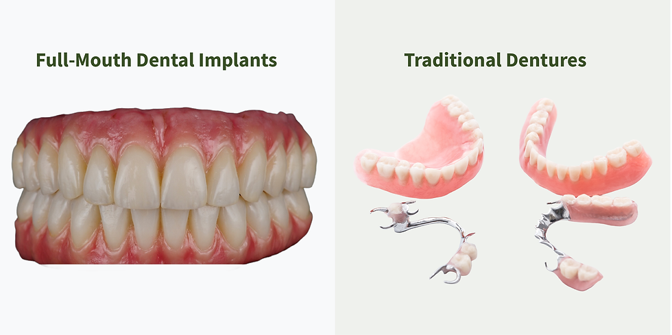 Full-Mouth Dental Implants vs. Traditional Dentures