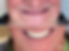 Before and after dental implant case2 in Vitality Teeth