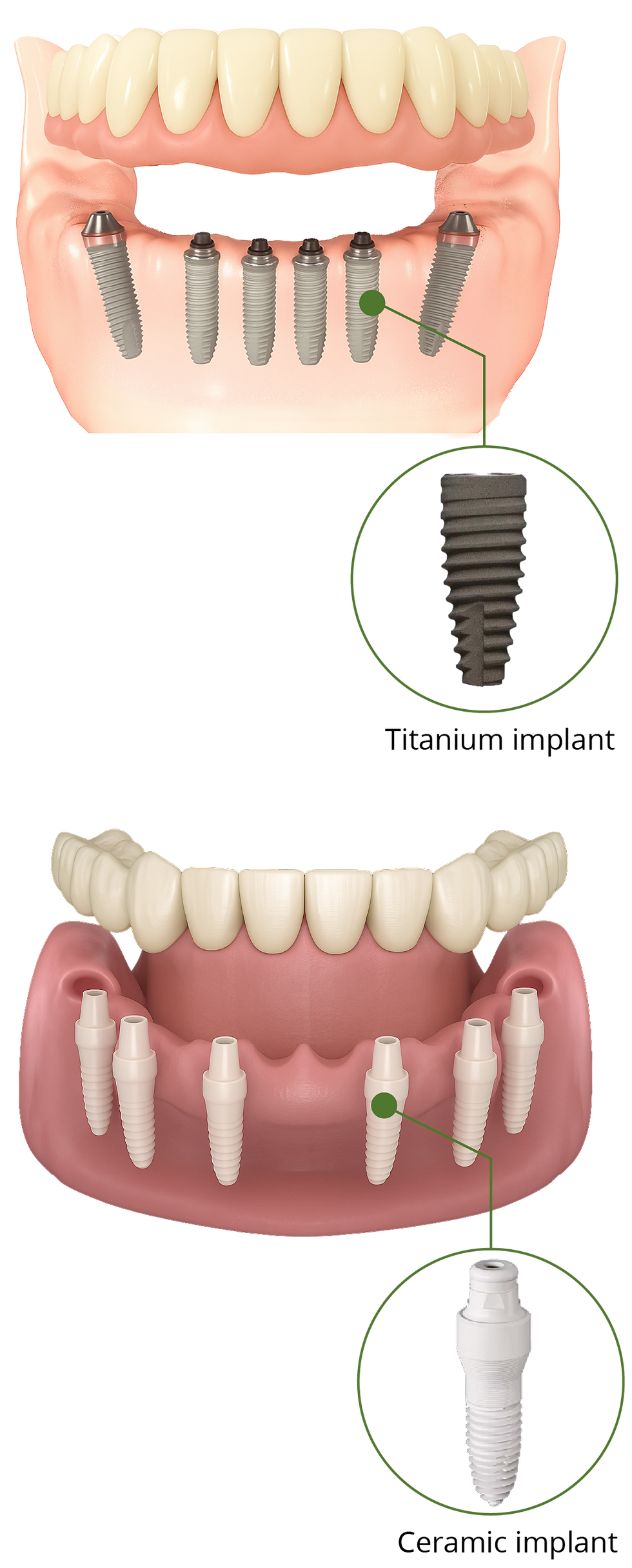 different implant materials — titanium implants