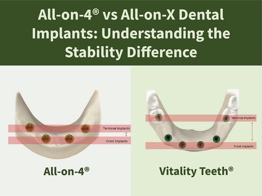 Stackable All On X All-on-4® vs All-on-X Dental Implants: Understanding the Stability ...