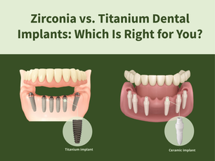 Titanium dental implants or Ceramic zirconia implants