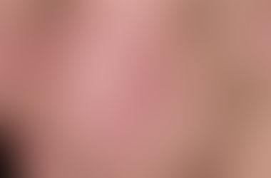 Sivilce Neden Oluşur