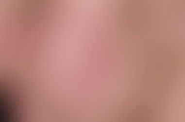 Sivilce Neden Oluşur