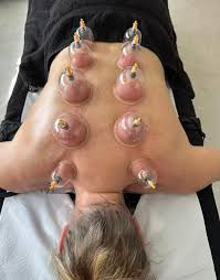 cupping 3