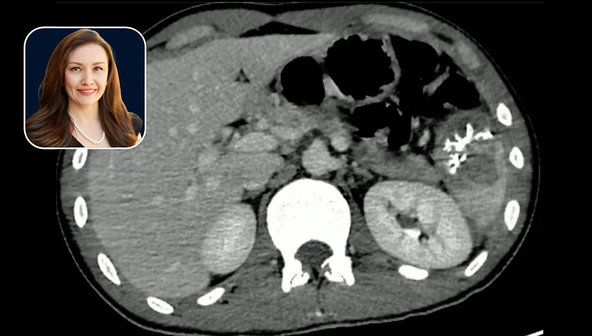 Strategies for Distal Embolization Techniques