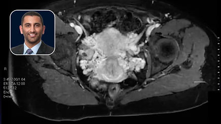 Left Ovarian Vein Embolization in a Patient with Renal Vein Compression