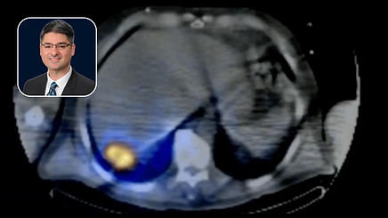 Y90 Radioembolization via Right Inferior Phrenic Artery for Recurrent HCC