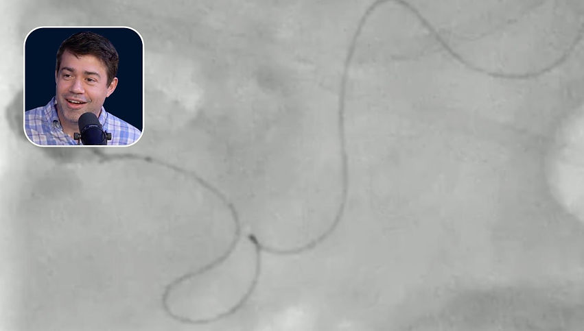 Liquid Embolization in Gastrointestinal Bleeding Management