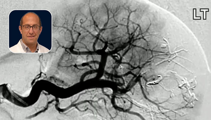 Subselective Embolization in Trauma-Induced Splenic Pseudoaneurysms