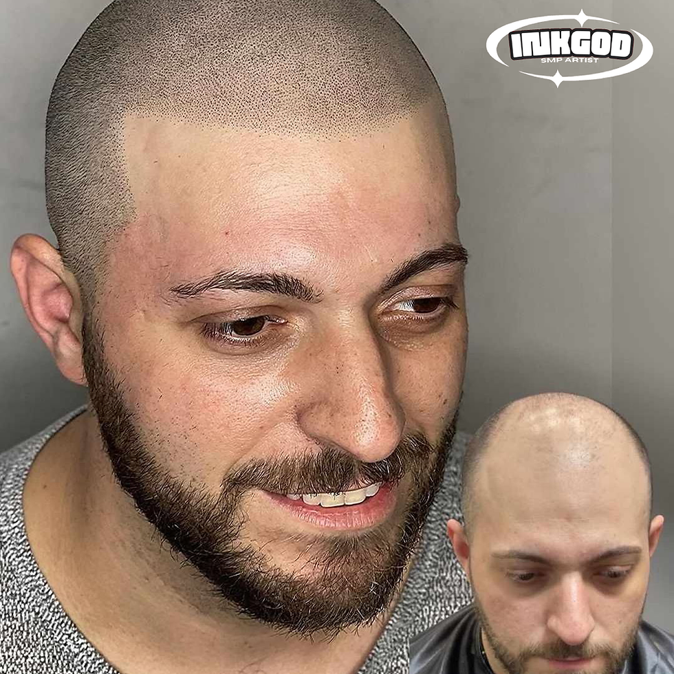 SMP vs Hair Transplant in new york