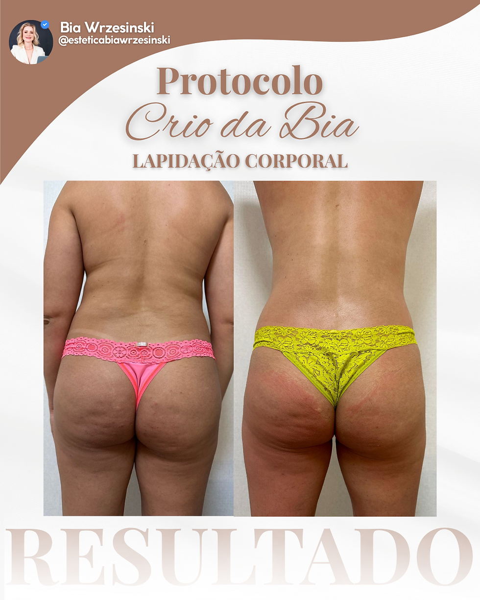 Protocolo Crio da Bia - Lapidação Corporal