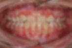 MALOCCLUSION DE CLASSE III