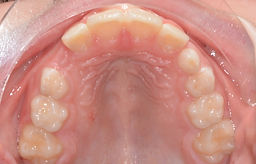Post frenectomy (2).jpg