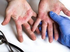Dermatitis
