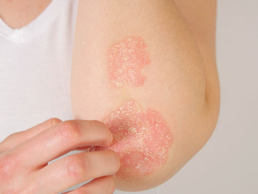 האם כדאי לעבור מטיפול עם נוגדי               IL-23 (Skyrizi,Tremfya)                               לנוגדי IL-17 (Taltz, Cosentyx) ?