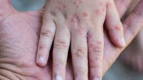 Confirman 25 casos de coxsackie en San Juan del Río