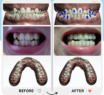隱形牙套 箍牙 香港箍牙 免費線上評估 香港註冊牙醫 固定器 retainer 全瓷牙貼