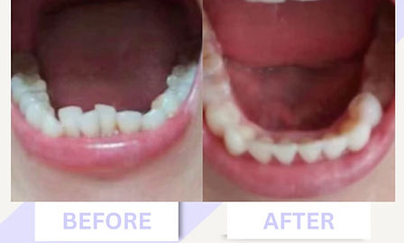 隱形牙套 箍牙 香港箍牙 免費線上評估 香港註冊牙醫 固定器 retainer 全瓷牙貼