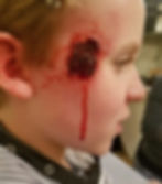 bullet exit wound