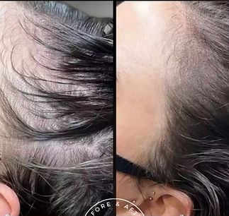 Scalp Micro Pigmentatie haarlijn opvullen
