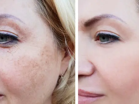 Treating hyperpigmentation with red light therapy