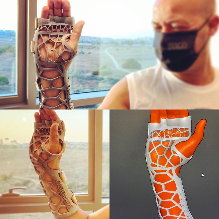 גבס מודפס, הדפסת תלת מימד
